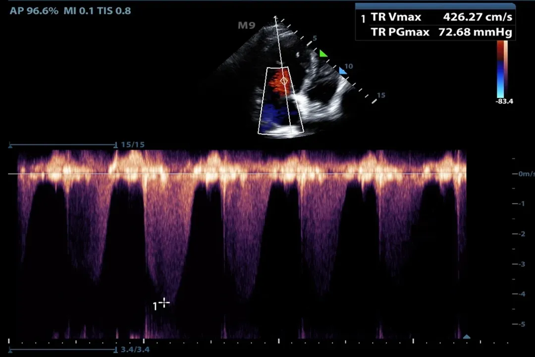 How does ultrasound imaging function?, Echo Reception