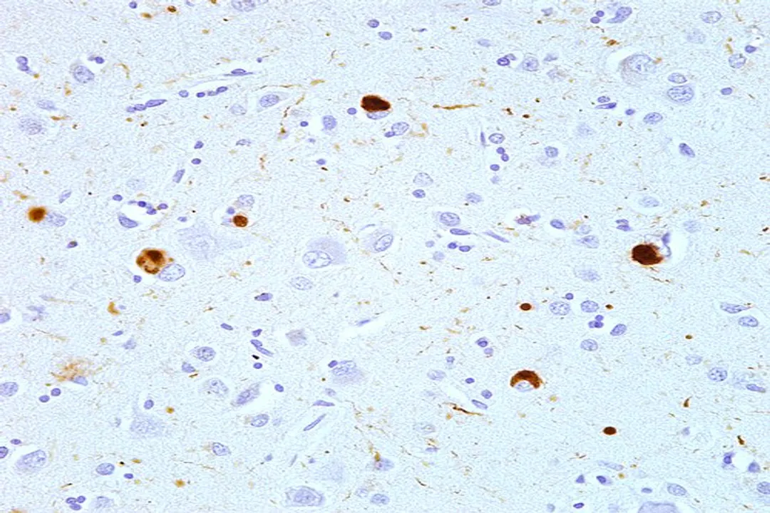 What causes protein misfolding diseases?, Misfolding Triggers