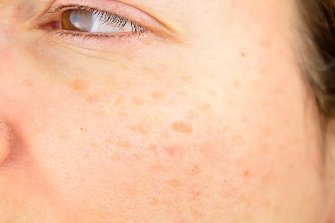 How do you treat photodamage?, Risk Factors