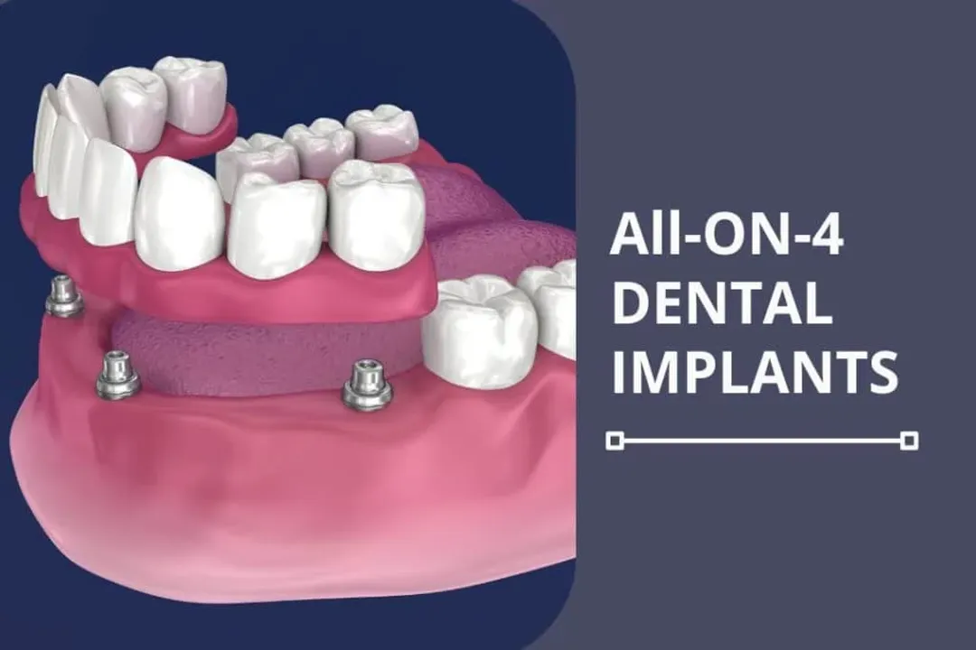 What are implants used for?, Device Placement