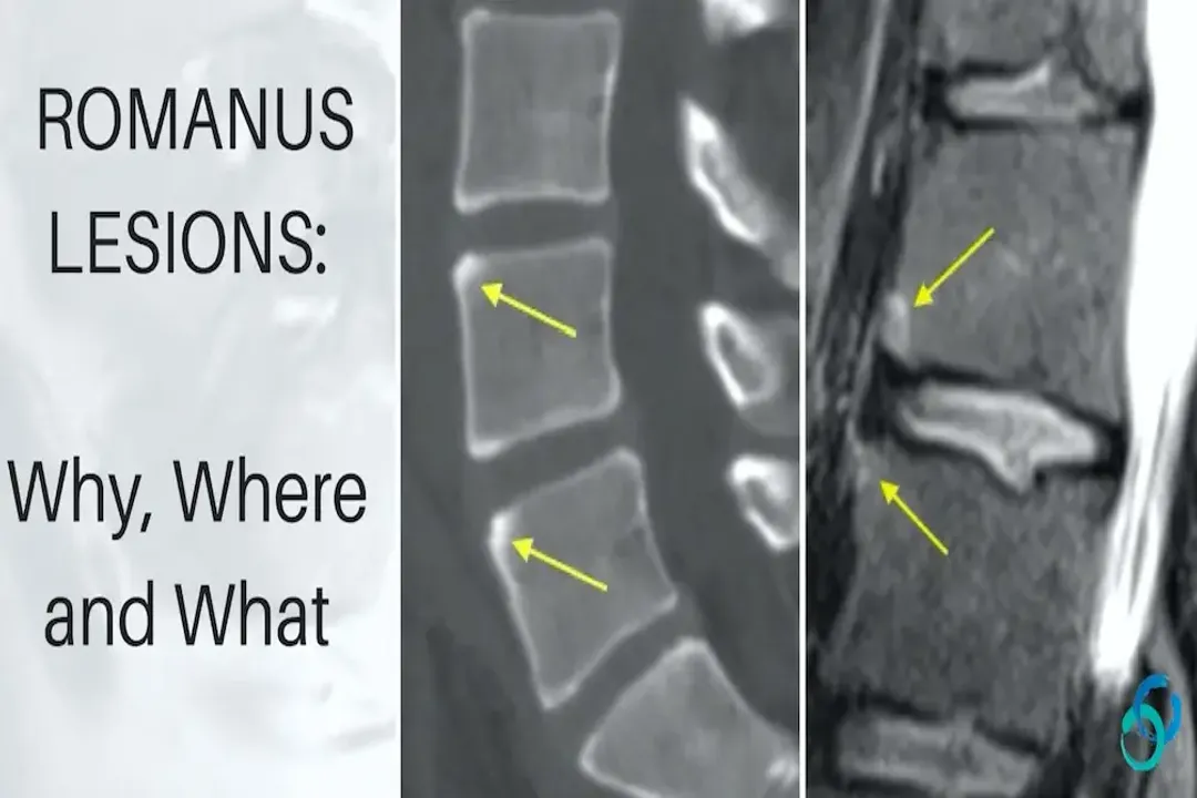 What causes Romanus lesion?