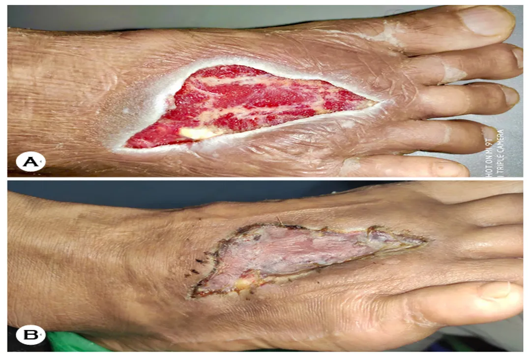 What disease does Edwardsiella tarda cause?