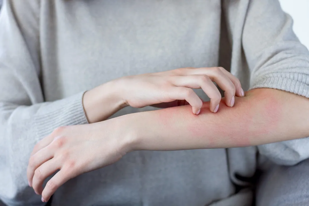 What is the most common skin irritant?, Irritant versus Allergy