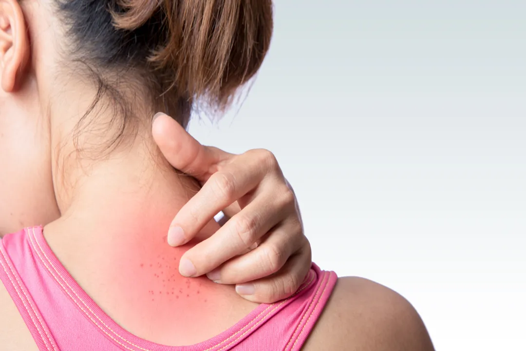 What is the most common skin irritant?