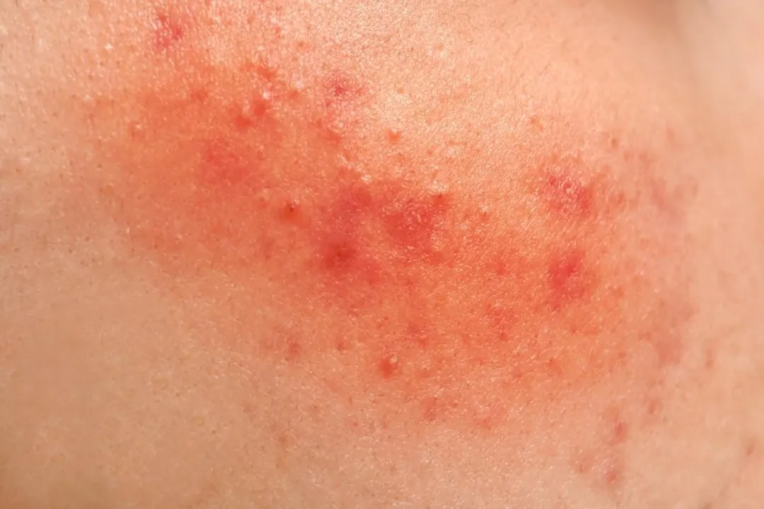 What would cause a sudden rash?, Red Skin
